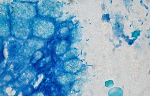 Helicobacter pylori sprzyja rakowi żołądka