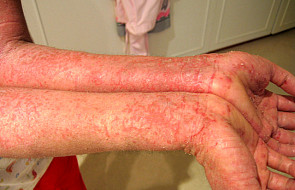 Atopowe zapalenie skóry - mitycza choroba