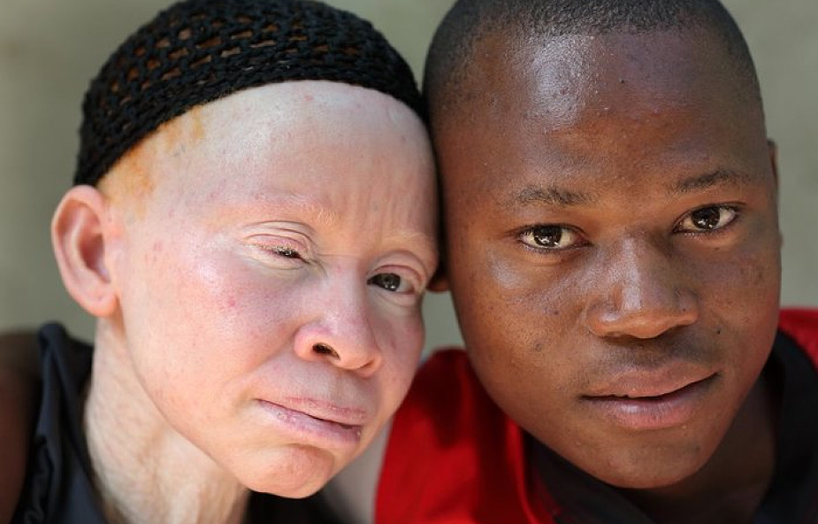Afryka: trzeba skończyć z przemocą wobec albinosów