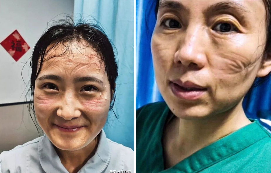 Chińskie pielęgniarki pokazały jak wyglądają po godzinach walki z koronawirusem