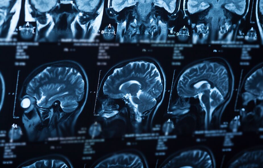 Naukowcy chcą wiedzieć, jak Covid-19 wpływa na mózg